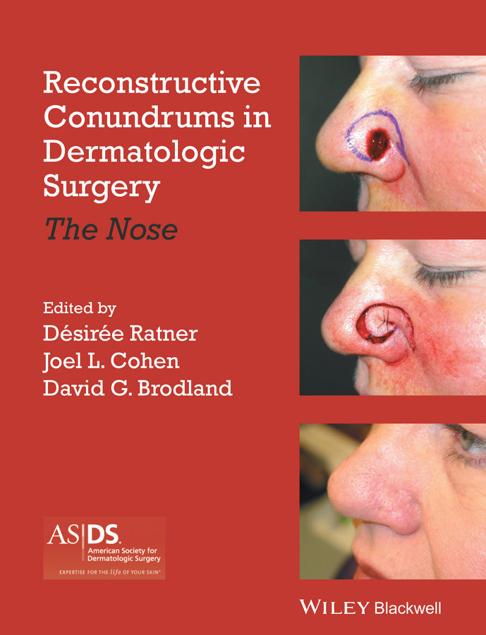 Reconstructive Conundrums in Dermatologic Surgery; The Nose (Hardback) 9781118272329
