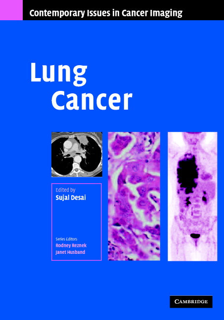 Lung Cancer (Hardback) 9780521872027