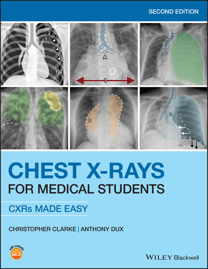 Chest X–rays for Medical Students – CXRs Made Easy 2nd Edition (Paperback / softback) 9781119504153