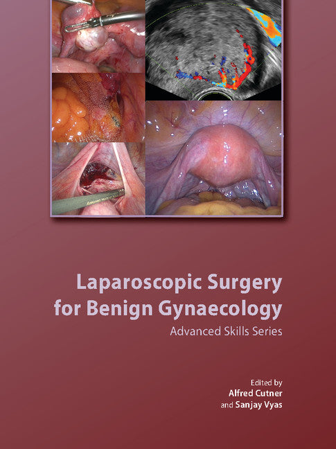 Laparoscopic Surgery for Benign Gynaecology Hardback with DVDs (Multiple-component retail product) 9781906985318