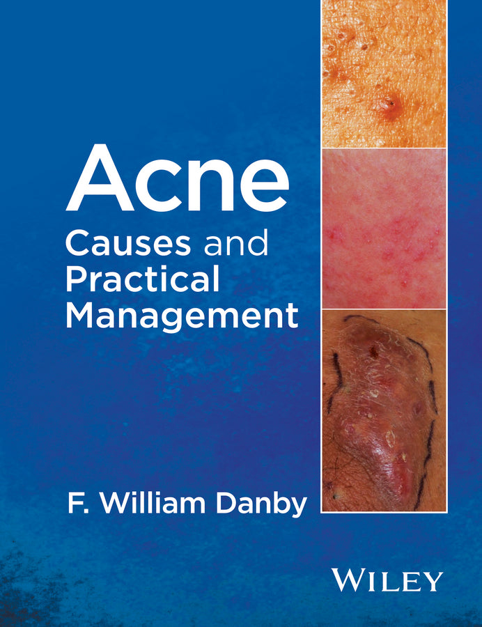 Acne; Causes and Practical Management (Hardback) 9781118232774