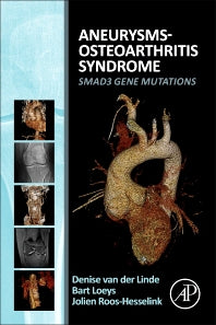 Aneurysms-Osteoarthritis Syndrome; SMAD3 Gene Mutations (Paperback) 9780128027080