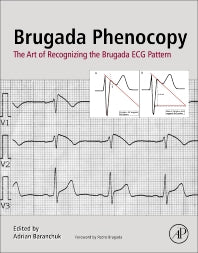 Brugada Phenocopy; The Art of Recognizing the Brugada ECG Pattern (Paperback) 9780128111512