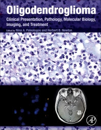 Oligodendroglioma; Clinical Presentation, Pathology, Molecular Biology, Imaging, and Treatment (Hardback) 9780128131589