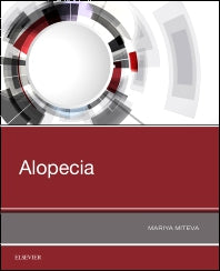 Alopecia (Paperback / softback) 9780323548250