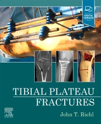 Tibial Plateau Fractures (Hardback) 9780323825689