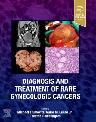 Diagnosis and Treatment of Rare Gynecologic Cancers (Hardback) 9780323829380