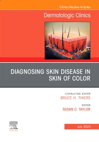 Diagnosing Skin Disease in Skin of Color, An Issue of Dermatologic Clinics (Hardback) 9780323940375