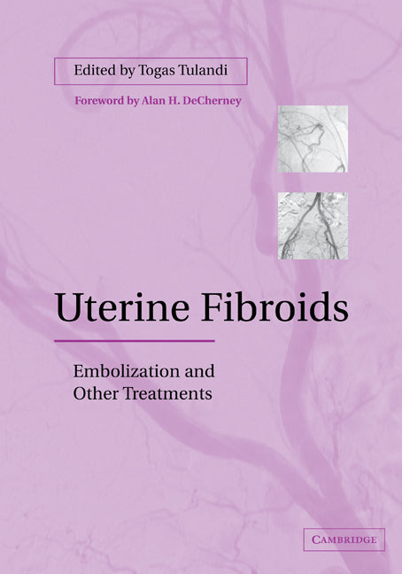 Uterine Fibroids; Embolization and other Treatments (Paperback) 9780521184199