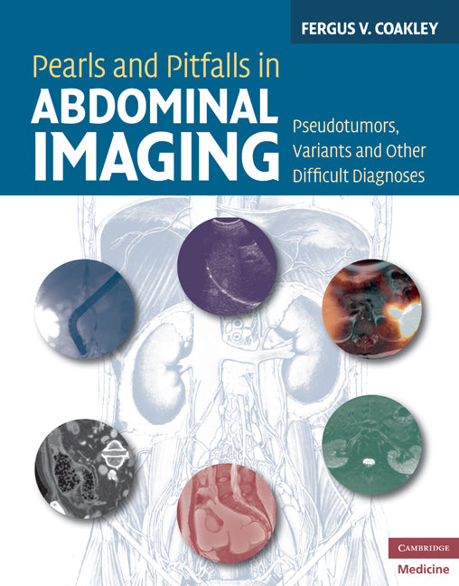 Pearls and Pitfalls in Abdominal Imaging; Pseudotumors, Variants and Other Difficult Diagnoses (Hardback) 9780521513777