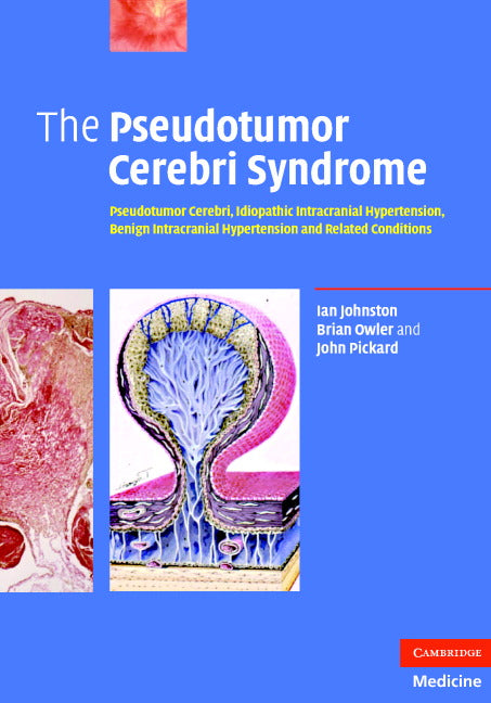 The Pseudotumor Cerebri Syndrome; Pseudotumor Cerebri, Idiopathic Intracranial Hypertension, Benign Intracranial Hypertension and Related Conditions (Hardback) 9780521869195