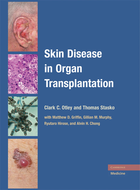 Skin Disease in Organ Transplantation (Hardback) 9780521870672