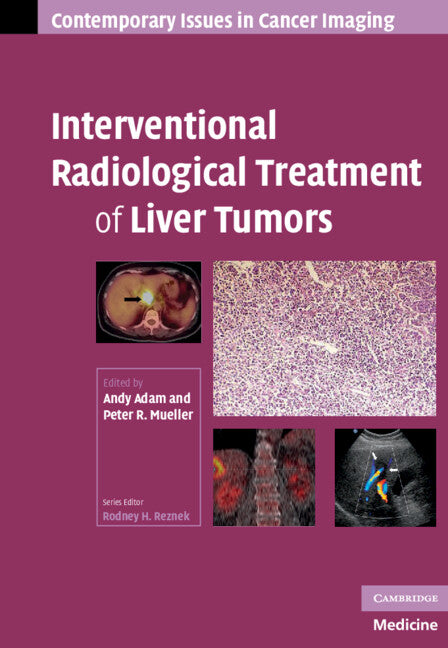 Interventional Radiological Treatment of Liver Tumors (Hardback) 9780521886871