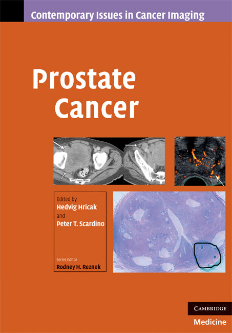 Prostate Cancer (Hardback) 9780521887045