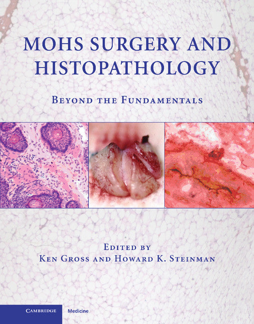 Mohs Surgery and Histopathology; Beyond the Fundamentals (Hardback) 9780521888042