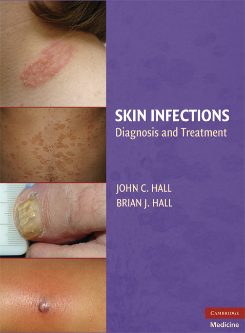 Skin Infections; Diagnosis and Treatment (Hardback) 9780521897297