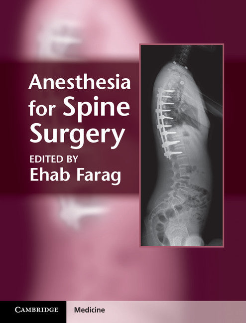 Anesthesia for Spine Surgery (Hardback) 9781107005310