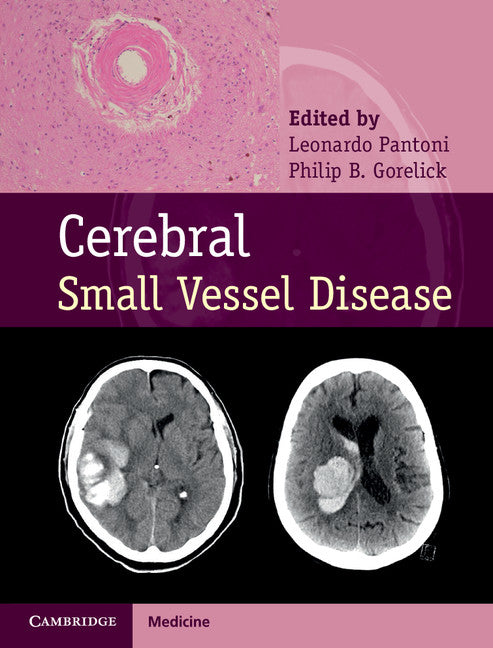 Cerebral Small Vessel Disease (Hardback) 9781107031661