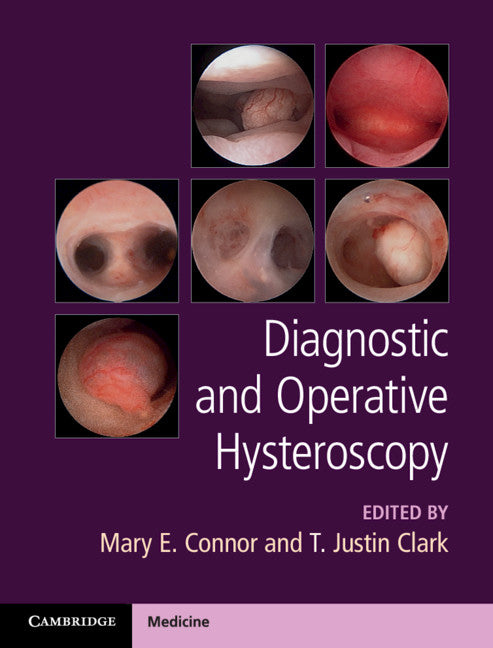 Diagnostic and Operative Hysteroscopy (Hardback) 9781107111608