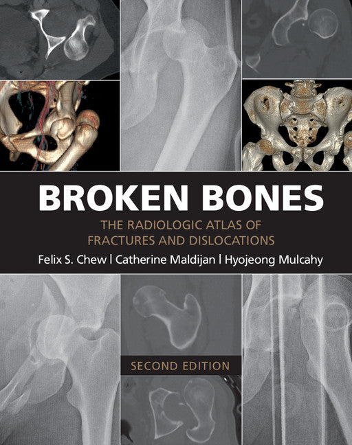 Broken Bones; The Radiologic Atlas of Fractures and Dislocations (Paperback / softback) 9781107499232