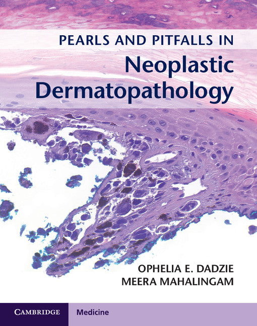 Pearls and Pitfalls in Neoplastic Dermatopathology with Online Access (Multiple-component retail product) 9781107584587