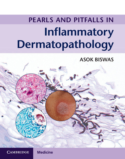 Pearls and Pitfalls in Inflammatory Dermatopathology (Multiple-component retail product) 9781316605998